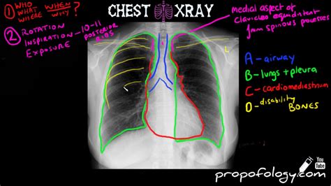 how to cheat chest x ray results|Top 5 Chest X.